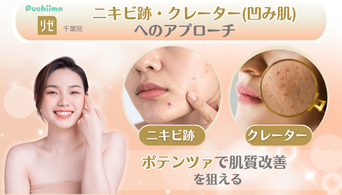 リゼクリニック千葉美肌治療ニキビ跡・クレーター凹み肌へのアプローチ