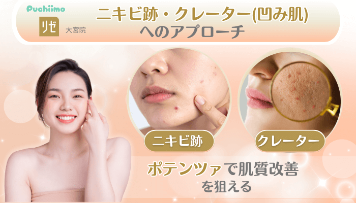 リゼクリニック大宮美肌治療ニキビ跡・クレーター凹み肌へのアプローチ