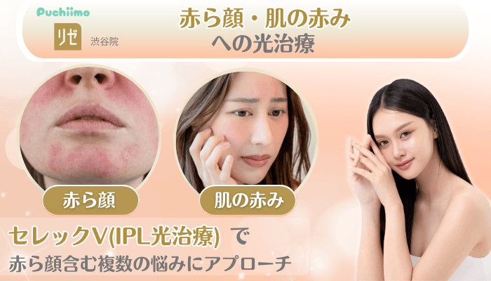 リゼクリニック渋谷美肌治療赤ら顔・肌の赤みへの光治療