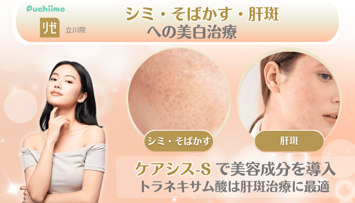 リゼクリニック立川美肌治療シミ・そばかす・肝斑への美白治療