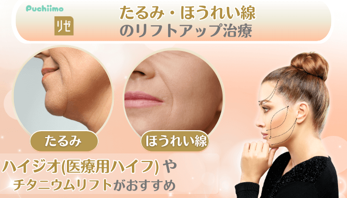 リゼクリニック美肌治療たるみ・ほうれい線のリフトアップ治療