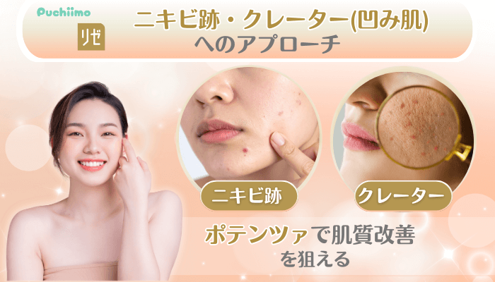 リゼクリニック美肌治療ニキビ跡・クレーター凹み肌へのアプローチ