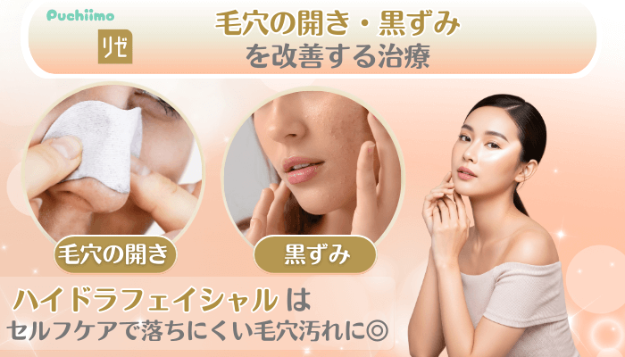 リゼクリニック美肌治療毛穴の開き・黒ずみを改善する治療