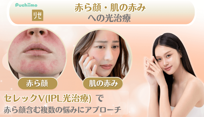 リゼクリニック美肌治療赤ら顔・肌の赤みへの光治療