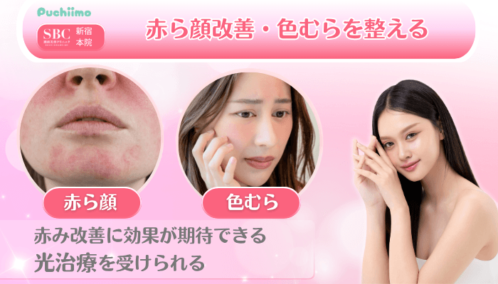SBC新宿美肌治療赤ら顔改善・色むらを整える