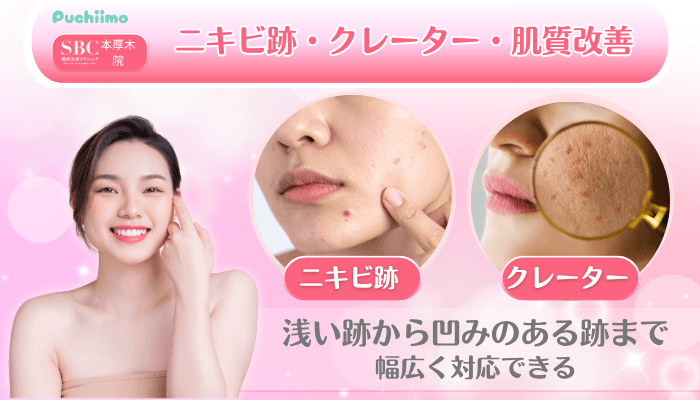 SBC本厚木美肌治療ニキビ跡・クレーター・肌質改善
