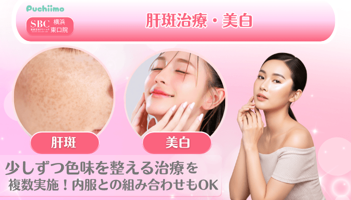 SBC横浜東口美肌治療肝斑治療・美白