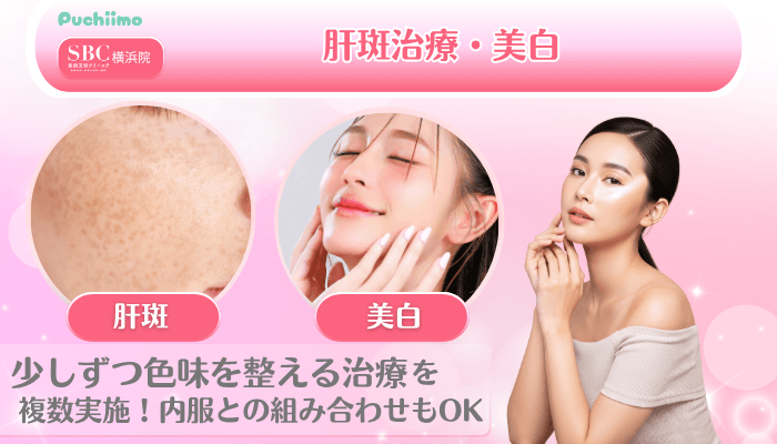 SBC横浜美肌治療肝斑治療・美白