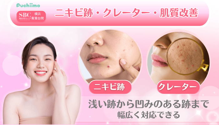 SBC横浜青葉台美肌治療ニキビ跡・クレーター・肌質改善