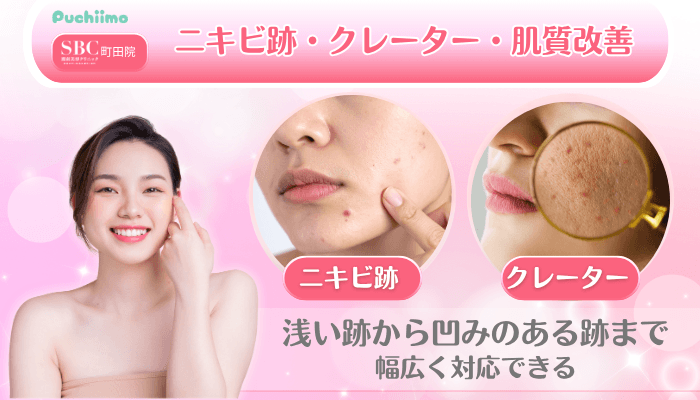 SBC町田美肌治療ニキビ跡・クレーター・肌質改善