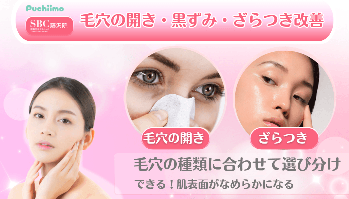 SBC藤沢美肌治療毛穴の開き・黒ずみ・ざらつき改善
