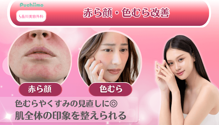 品川美容外科美肌治療赤ら顔・色むら改善