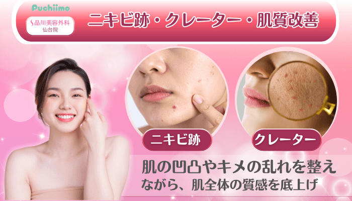 品川美容外科仙台美肌治療ニキビ跡・クレーター・肌質改善